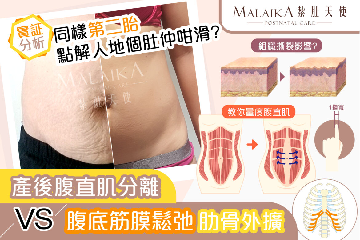 產後腹直肌分離症 專題圖解分析 Malaika 紮肚天使 產後腹直肌分離症 專題圖解分析 Malaika 紮肚天使